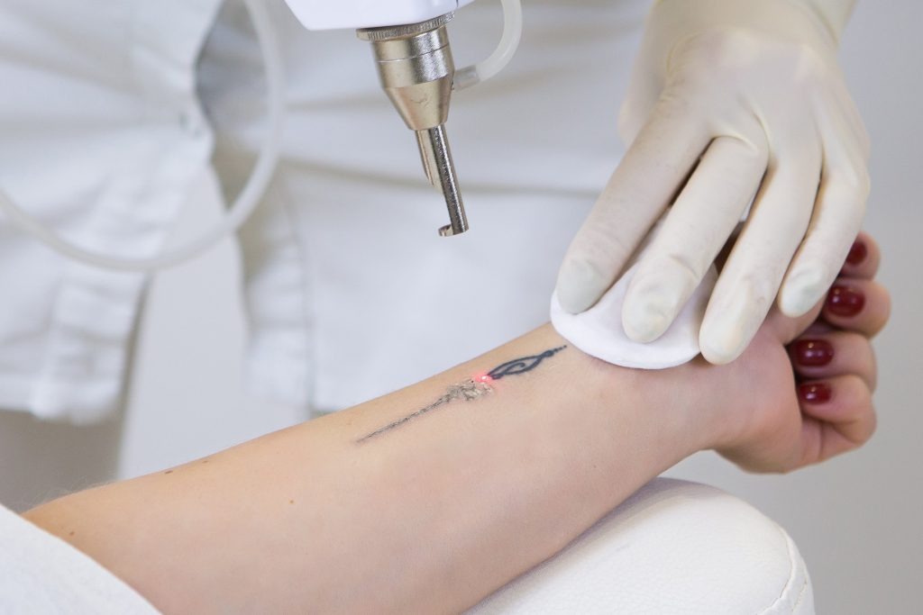 5 Compelling Reasons to Consider Removing Your Tattoo